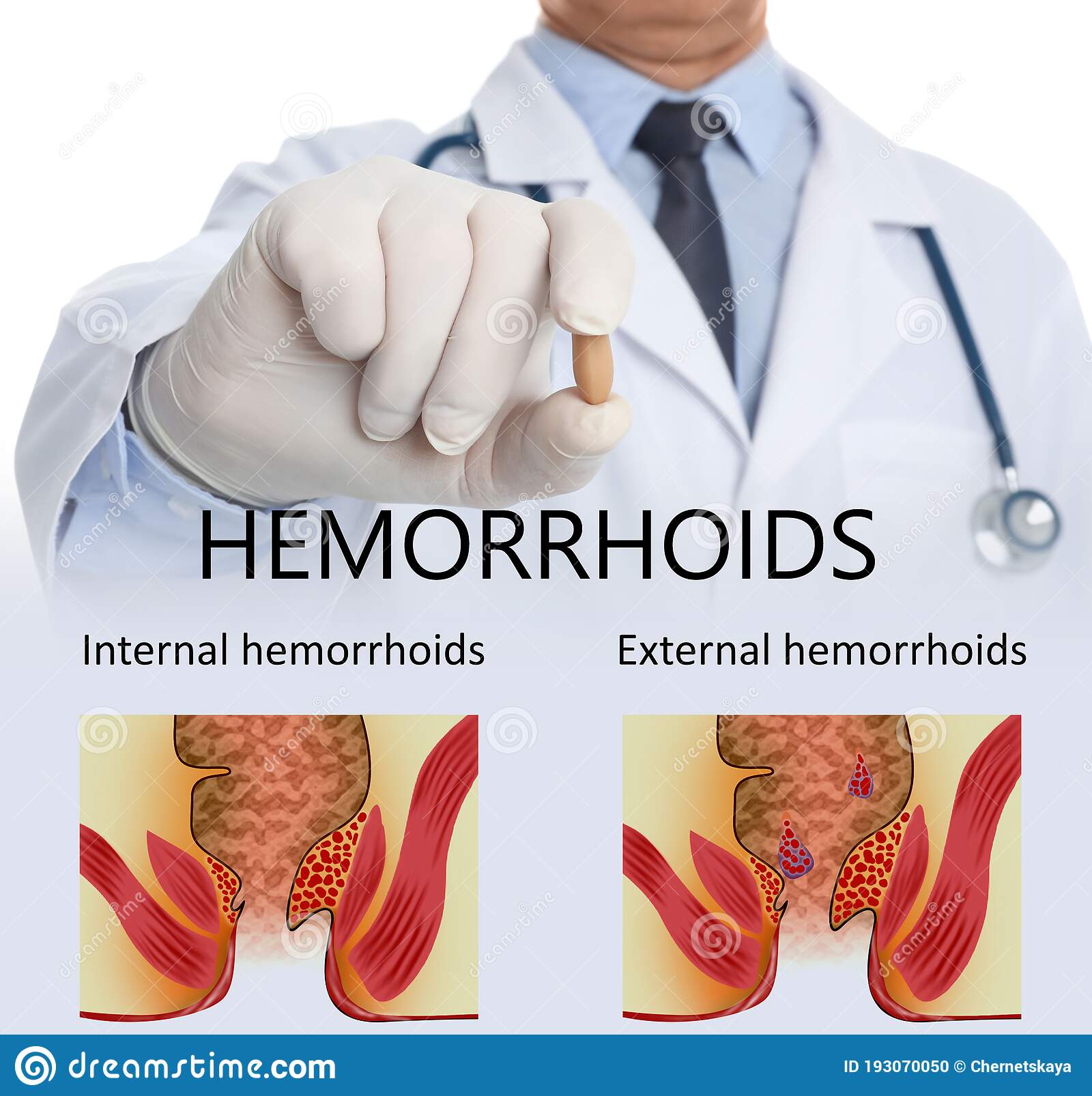 Dr berg on hemorrhoids