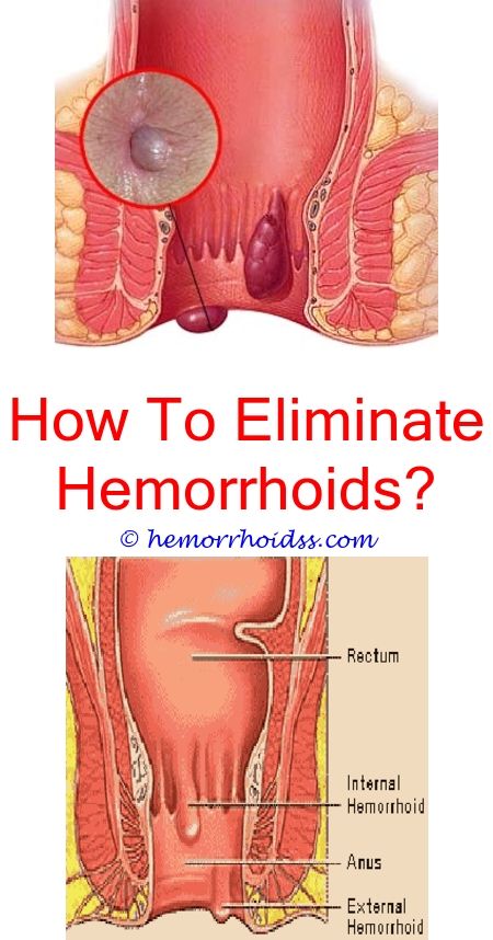 hemorrhoidtreatment how do you stop hemorrhoids from ...