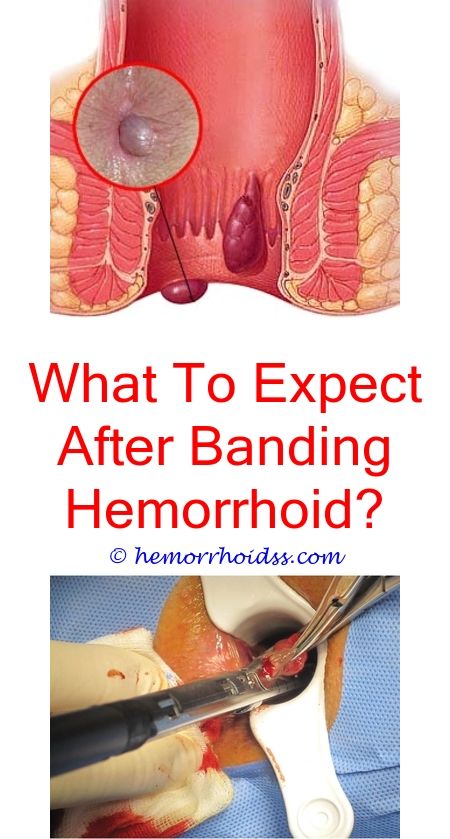 How To Get Rid Of Inner Hemorrhoids? when will my hemorrhoid go away ...