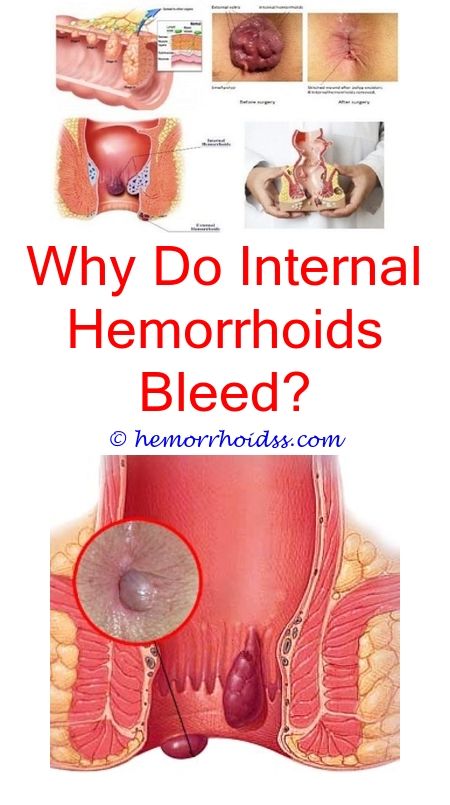 How To Prevent Hemorrhoids While Pregnant? how to shrink a ...
